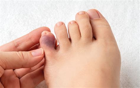 what to do for a stubbed pinky toe